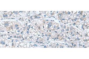 Immunohistochemistry of paraffin-embedded Human liver cancer tissue using GDF9 Polyclonal Antibody at dilution of 1:55(x200) (GDF9 anticorps)