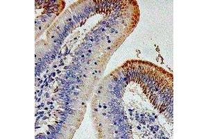 Immunohistochemical analysis of CD212 staining in human colon cancer formalin fixed paraffin embedded tissue section. (IL12RB1 anticorps)