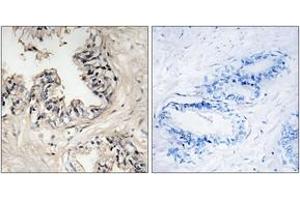 Immunohistochemistry analysis of paraffin-embedded human prostate carcinoma tissue, using MRPS36 Antibody.