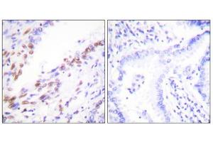 Immunohistochemistry analysis of paraffin-embedded human lung carcinoma tissue, using Ki67antibody. (Ki-67 anticorps  (C-Term))