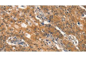 Immunohistochemistry of paraffin-embedded Human gastic cancer using DNM2 Polyclonal Antibody at dilution of 1:40