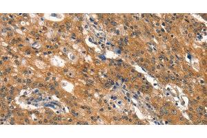 Immunohistochemistry of paraffin-embedded Human gastic cancer using DNM2 Polyclonal Antibody at dilution of 1:40 (DNM2 anticorps)