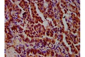 IHC image of ABIN7156289 diluted at 1:600 and staining in paraffin-embedded human lung cancer performed on a Leica BondTM system. (IMPDH1 anticorps  (AA 191-281))
