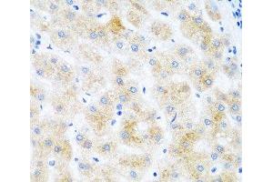 Immunohistochemistry of paraffin-embedded Human liver cancer using DHODH Polyclonal Antibody at dilution of 1:100 (40x lens).