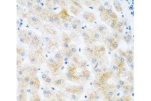 Immunohistochemistry of paraffin-embedded Human liver cancer using DHODH Polyclonal Antibody at dilution of 1:100 (40x lens). (DHODH anticorps)