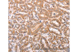 Immunohistochemistry of Human liver cancer using TRPV4 Polyclonal Antibody at dilution of 1:40 (TRPV4 anticorps)