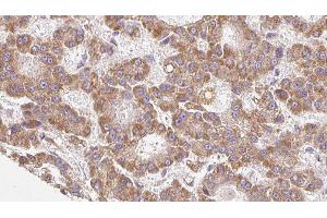 ABIN6279168 at 1/100 staining Human liver cancer tissue by IHC-P. (ABCC8 anticorps)
