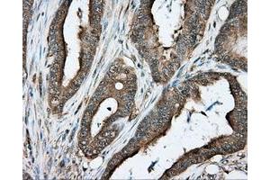 Immunohistochemical staining of paraffin-embedded liver tissue using anti-PRKAR2A mouse monoclonal antibody. (PRKAR2A anticorps)
