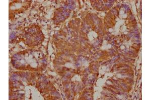 IHC image of ABIN7164792 diluted at 1:100 and staining in paraffin-embedded human colon cancer performed on a Leica BondTM system.