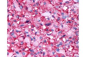 Anti-DRD4 / Dopamine Receptor D4 antibody IHC of human Brain, Glioblastoma.