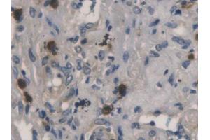 DAB staining on IHC-P; Samples: Human Lung cancer Tissue (RNASE3 anticorps  (AA 30-154))