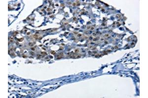 The image on the left is immunohistochemistry of paraffin-embedded Human breast cancer tissue using ABIN7190003(BPIFB1 Antibody) at dilution 1/25, on the right is treated with synthetic peptide. (BPIFB1 anticorps)