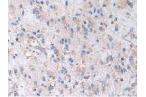 IHC-P analysis of Human Glioma Tissue, with DAB staining. (AKAP11 anticorps  (AA 1650-1901))