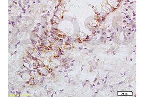 Formalin-fixed and paraffin embedded: human rectal carcinoma labeled with Anti-FasL Polyclonal Antibody, Unconjugated (ABIN726410) at 1:200, followed by conjugation to the secondary antibody and DAB staining (FASL anticorps  (AA 196-281))