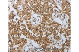 Immunohistochemistry of Human lung cancer using PSMD6 Polyclonal Antibody at dilution of 1:40 (PSMD6 anticorps)