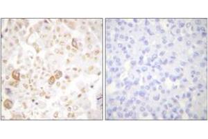 Immunohistochemistry analysis of paraffin-embedded human breast carcinoma tissue, using Cyclin F Antibody.