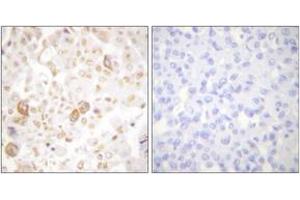 Immunohistochemistry analysis of paraffin-embedded human breast carcinoma tissue, using Cyclin F Antibody. (Cyclin F anticorps  (AA 737-786))