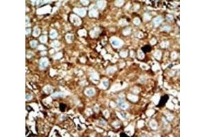 IHC analysis of FFPE human hepatocarcinoma tissue stained with the PFKFB3 antibody