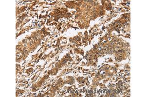 Immunohistochemistry of Human liver cancer using CALU Polyclonal Antibody at dilution of 1:40 (CALU anticorps)