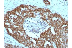 Formalin-fixed, paraffin-embedded human Ovarian carcinoma stained with Nucleolin Mouse Monoclonal Antibody (NCL/902).