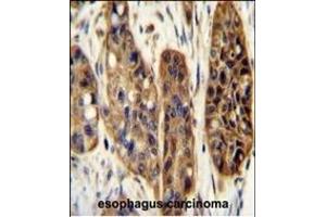 KIL Antibody (N-term) (ABIN654924 and ABIN2844567) immunohistochemistry analysis in formalin fixed and paraffin embedded human esophagus carcinoma followed by peroxidase conjugation of the secondary antibody and DAB staining. (KIAA1324-Like anticorps  (N-Term))