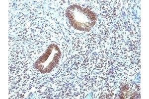 Formalin-fixed, paraffin-embedded human uterine carcinoma stained with MAP3K1 antibody (2F6).