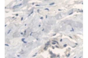 Detection of ANTXR2 in Human Thyroid cancer Tissue using Polyclonal Antibody to Anthrax Toxin Receptor 2 (ANTXR2)