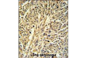 IMPDH2 Antibody IHC analysis in formalin fixed and paraffin embedded human Lung carcinoma followed by peroxidase conjugation of the secondary antibody and DAB staining.