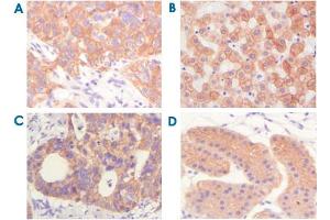 Immunohistochemical analysis of paraffin-embedded human lung squamous cell carcinoma (A) ,normal hepatocyte (B) , colon adenocacinoma? (Cytokeratin 5 anticorps)