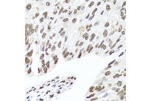 Immunohistochemistry of paraffin-embedded human prostate cancer using HNRNPR antibody at dilution of 1:100 (40x lens). (HNRNPR anticorps)