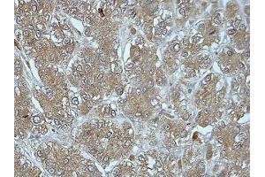 IHC analysis of formalin-fixed paraffin-embedded liver cancer tissue with cytoplasmic staining, using FUCA2 antibody (1/100 dilution). (FUCA2 anticorps  (AA 312-467))