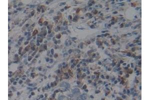 Detection of ACE in Human Breast cancer Tissue using Polyclonal Antibody to Angiotensin I Converting Enzyme (ACE)