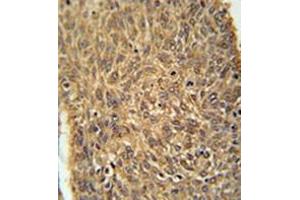 Immunohistochemistry analysis in formalin fixed and paraffin embedded human lung carcinoma reacted with KIAA0652 Antibody (N-term) followed which was peroxidase conjugated to the secondary antibody and followed byDAB staining. (ATG13 anticorps  (N-Term))