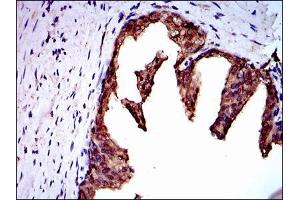 Immunohistochemical analysis of paraffin-embedded prostate cancer tissues using NEDD8 mouse mAb with DAB staining.
