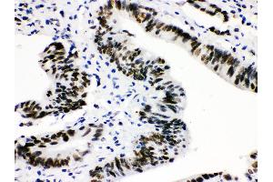 Anti-CTBP2 Picoband antibody, IHC(P) IHC(P): Human Intestinal Cancer Tissue (CTBP2 anticorps  (AA 321-445))