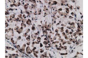Immunohistochemical staining of paraffin-embedded Adenocarcinoma of Human colon tissue using anti-GPHN mouse monoclonal antibody. (Gephyrin anticorps)