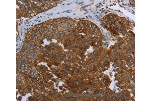 Immunohistochemistry of Human ovarian cancer using SNCG Polyclonal Antibody at dilution of 1:60 (SNCG anticorps)