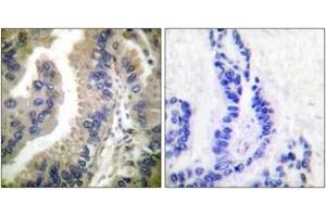 Immunohistochemistry analysis of paraffin-embedded human lung carcinoma tissue, using HSP90A Antibody.