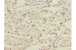 Immunohistochemistry of paraffin-embedded human gastric cancer using ABIN7167348 at dilution of 1:100 (RAB4B anticorps  (AA 2-213))