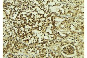ABIN6267213 at 1/100 staining Human breast cancer tissue by IHC-P. (CDK6 anticorps  (pTyr24))