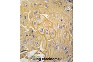 Formalin-fixed and paraffin-embedded human lung carcinoma tissue reacted with MCK10 antibody (ABIN392016 and ABIN2841793) , which was peroxidase-conjugated to the secondary antibody, followed by DAB staining. (DDR1 anticorps)