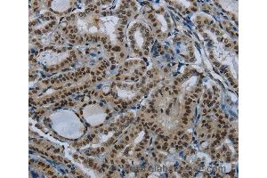 Immunohistochemistry of Human thyroid cancer using NBL1 Polyclonal Antibody at dilution of 1:50 (PARN anticorps)