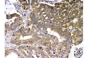 GAD65 was detected in paraffin-embedded sections of human intetsinal cancer tissues using rabbit anti- GAD65 Antigen Affinity purified polyclonal antibody (Catalog #) at 1 µg/mL.