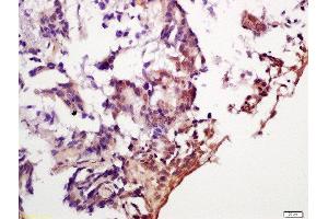 Formalin-fixed and paraffin embedded human gastric cancer labeled with Anti-phospho-eIF4EBP1 (Ser65 + Thr70) Polyclonal Antibody, Unconjugated  at 1:200 followed by conjugation to the secondary antibody and DAB staining