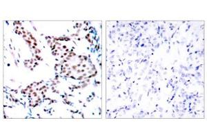 Immunohistochemical analysis of paraffin-embedded human breast carcinoma tissue using c-Jun (Ab-170) antibody (E021023). (C-JUN anticorps)
