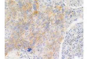 ABIN6256281 and ABIN6267651 at 1/100 staining human esophageal carcinoma by IHC-P. (Caspase 8 anticorps  (pSer347))