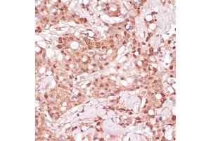 Immunohistochemistry of paraffin-embedded human breast cancer using BYSL antibody (ABIN6129546, ABIN6137672, ABIN6137674 and ABIN6215553) at dilution of 1:100 (40x lens).