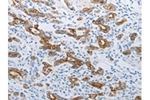 The image on the left is immunohistochemistry of paraffin-embedded Human gastric cancer tissue using ABIN7192809(TMEM8B Antibody) at dilution 1/15, on the right is treated with synthetic peptide. (TMEM8B anticorps)