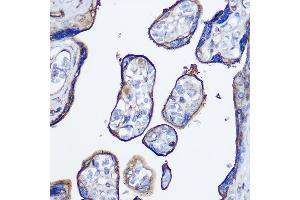 Immunohistochemistry of paraffin-embedded human colon carcinoma using cGAS Rabbit pAb (ABIN6134073, ABIN6143590, ABIN6143591 and ABIN6224360) at dilution of 1:50 (40x lens). (C6orf150 anticorps  (AA 350-522))