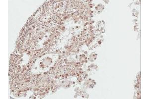 IHC-P Image Immunohistochemical analysis of paraffin-embedded human ovarian cancer, using DDI1, antibody at 1:100 dilution.